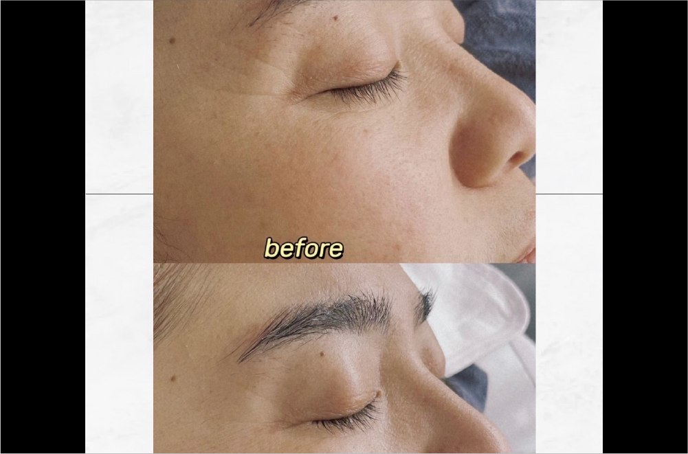 サーマルフラクショナルRF 症例写真1