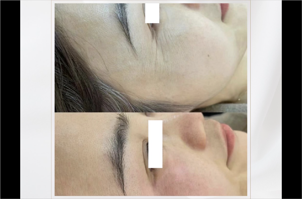 サーマルフラクショナルRF 症例写真2