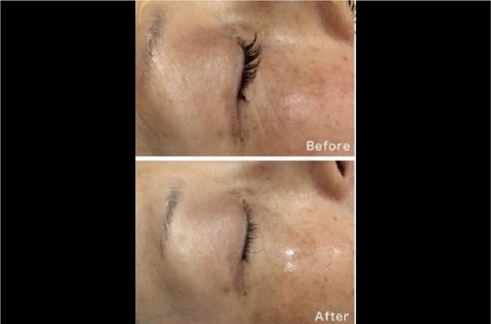 サーマルフラクショナルRF 症例写真3