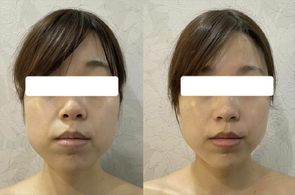 サーマルフラクショナルRF 症例写真4