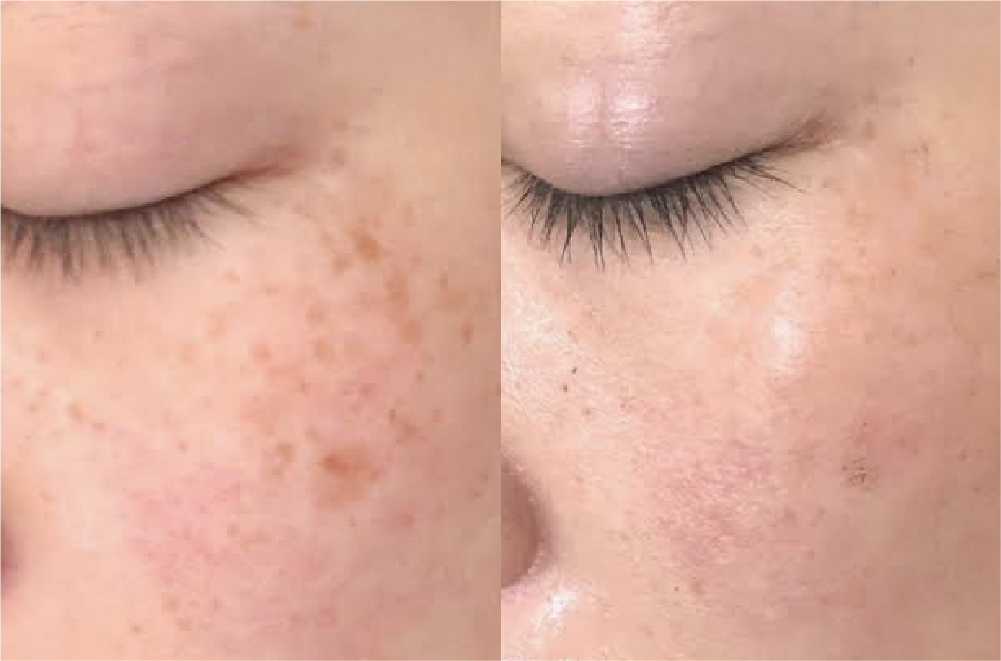 サーマルフラクショナルRF 症例写真5