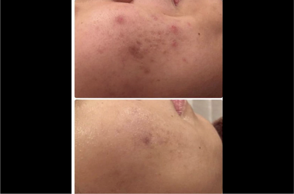 クリスティーナ「ハーブピーリング」 症例写真2