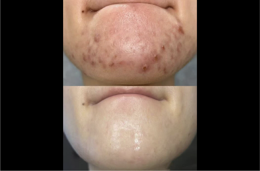 クリスティーナ「ハーブピーリング」 症例写真3