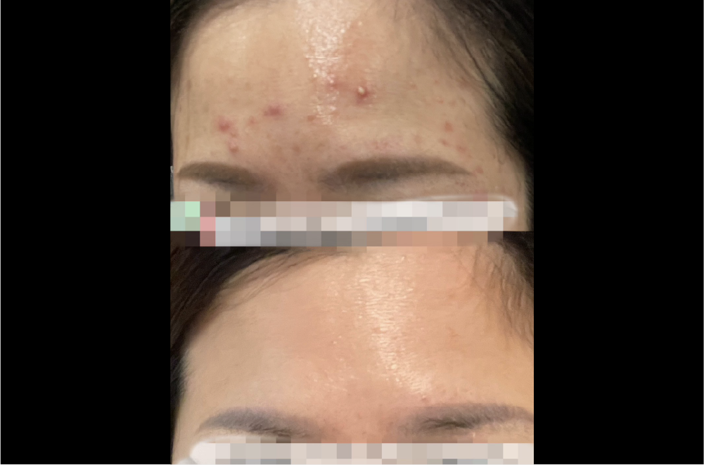 クリスティーナ「ハーブピーリング」 症例写真4