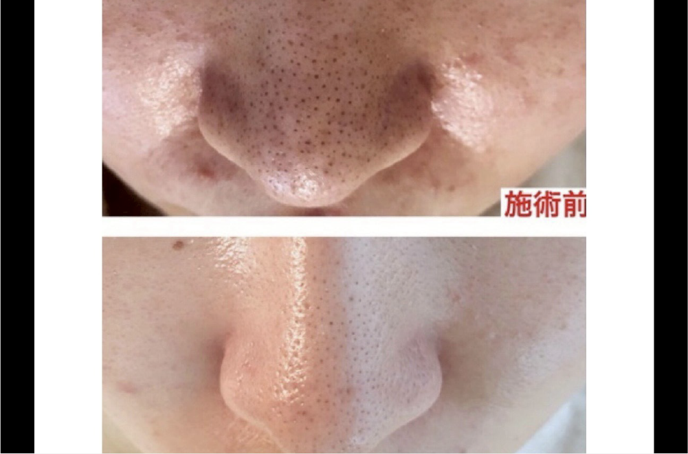 クリスティーナ「ハーブピーリング」 症例写真5