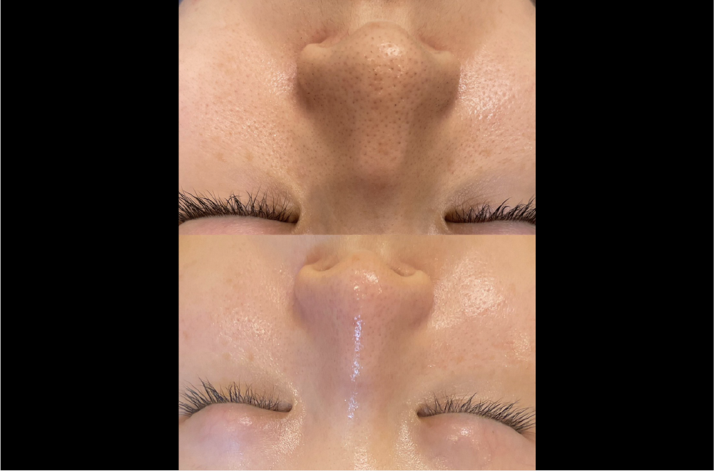 クリスティーナ「ハーブピーリング」 症例写真6