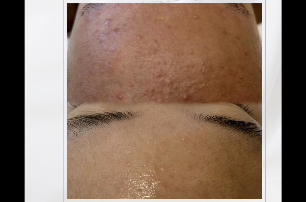クリスティーナ「ハーブピーリング」 症例写真7