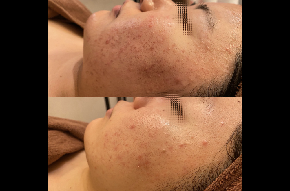 クリスティーナ「ハーブピーリング」 症例写真8