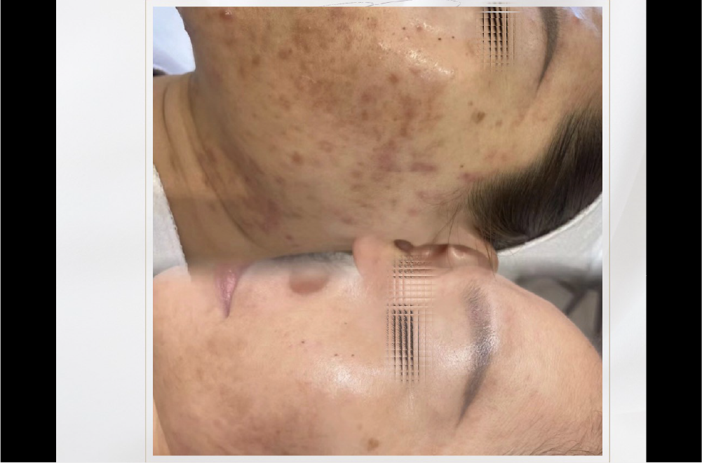 クリスティーナ「ハーブピーリング」 症例写真9