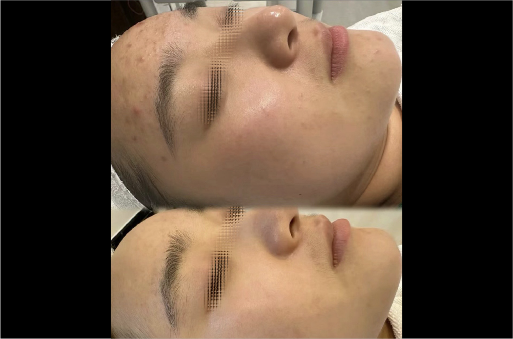 クリスティーナ「ハーブピーリング」 症例写真10