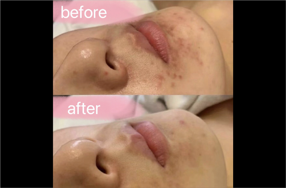 クリスティーナ「ハーブピーリング」 症例写真11