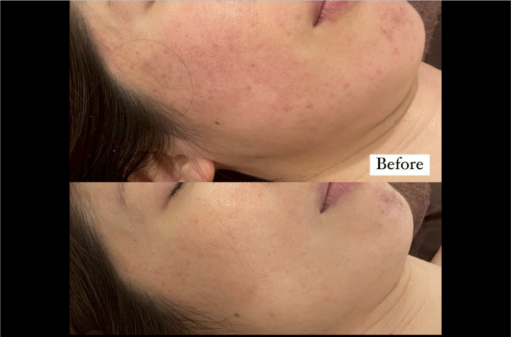 クリスティーナ「ハーブピーリング」 症例写真12