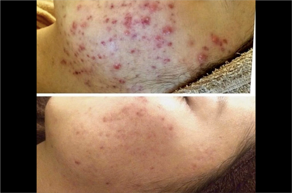 クリスティーナ「ハーブピーリング」 症例写真13