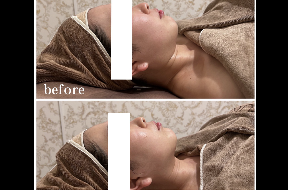 レモンボトル(脂肪溶解) 症例写真1