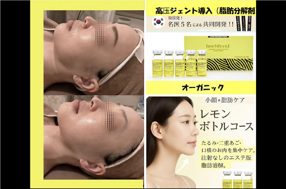 レモンボトル(脂肪溶解) 症例写真2