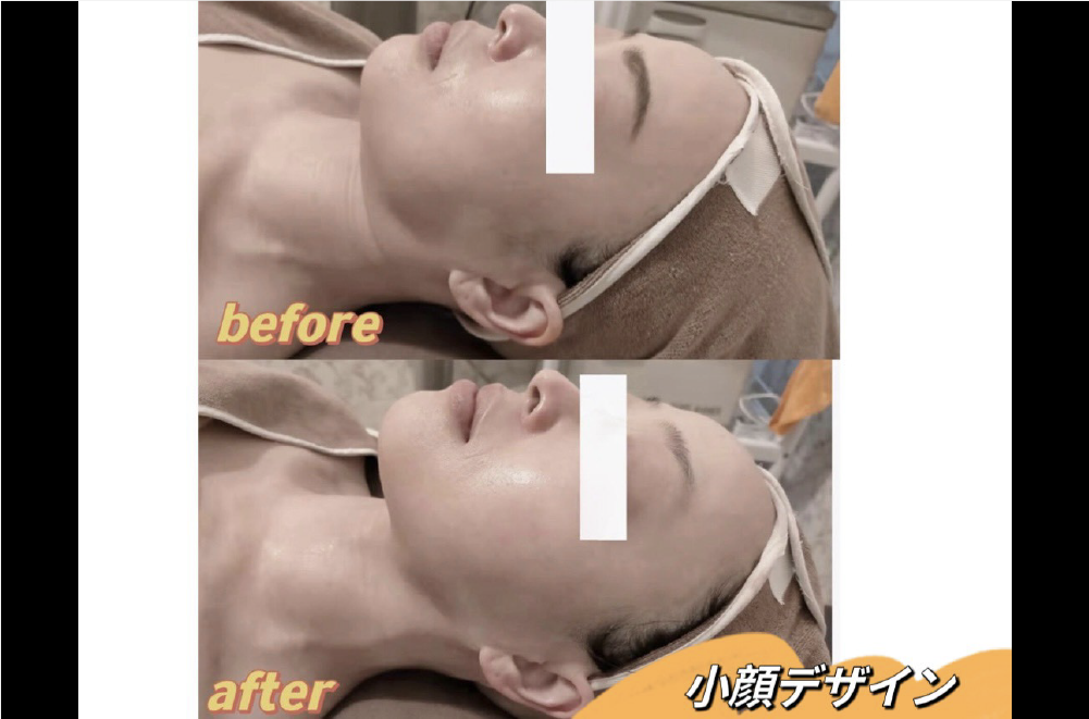 レモンボトル(脂肪溶解) 症例写真4