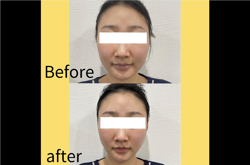 レモンボトル(脂肪溶解) 症例写真5