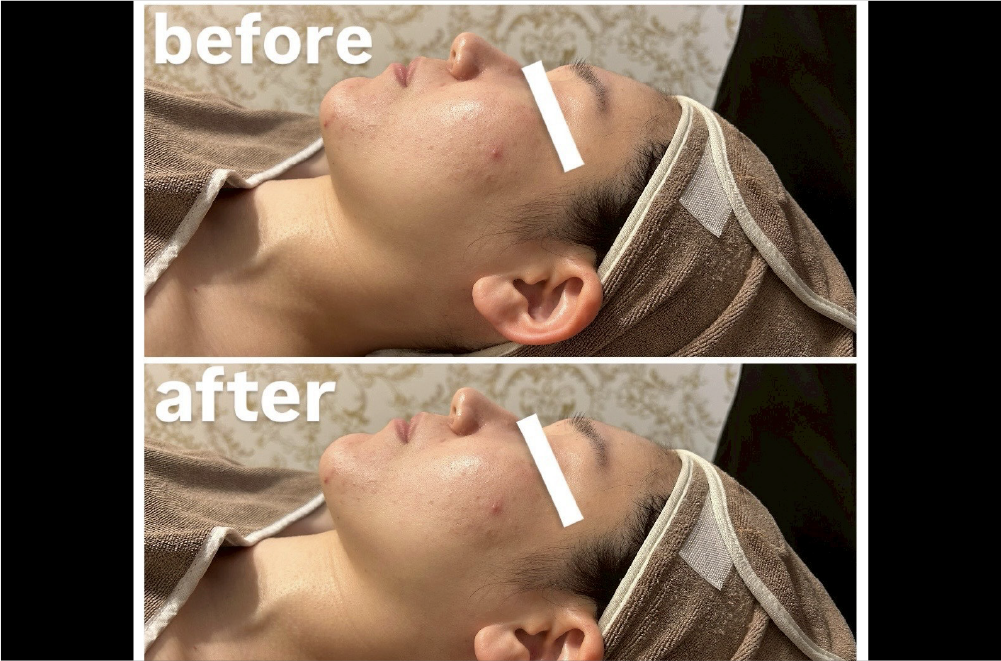 レモンボトル(脂肪溶解) 症例写真8