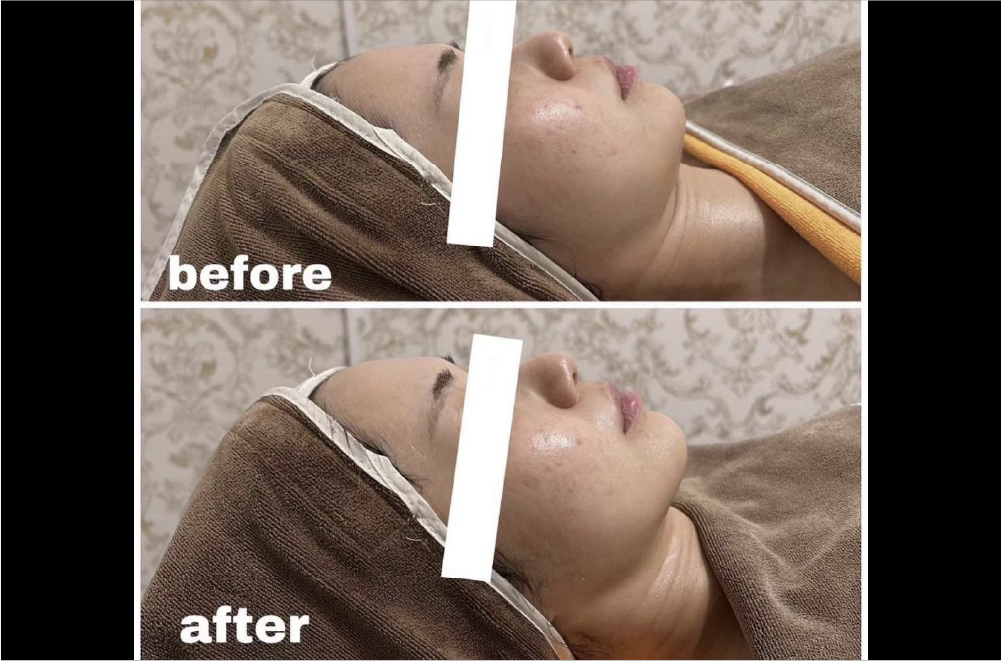 レモンボトル(脂肪溶解) 症例写真9