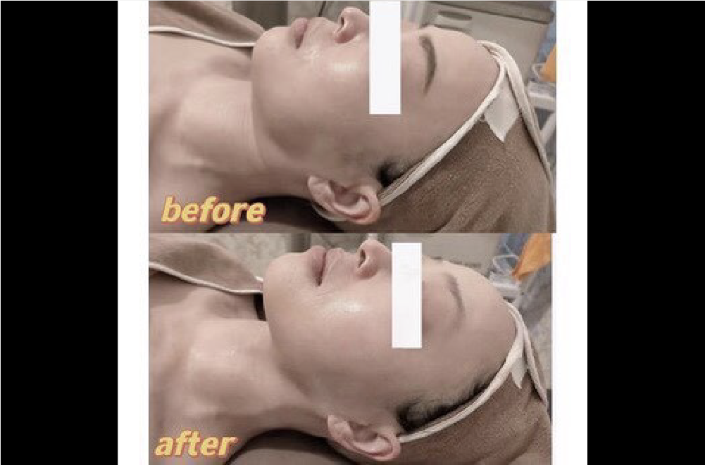 レモンボトル(脂肪溶解) 症例写真11