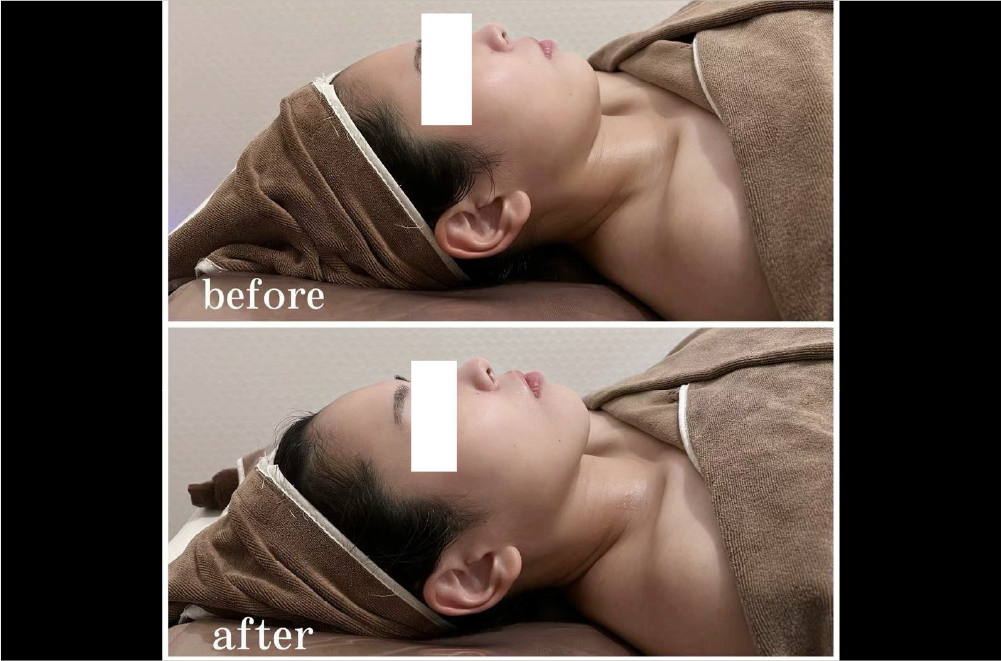 レモンボトル(脂肪溶解) 症例写真12