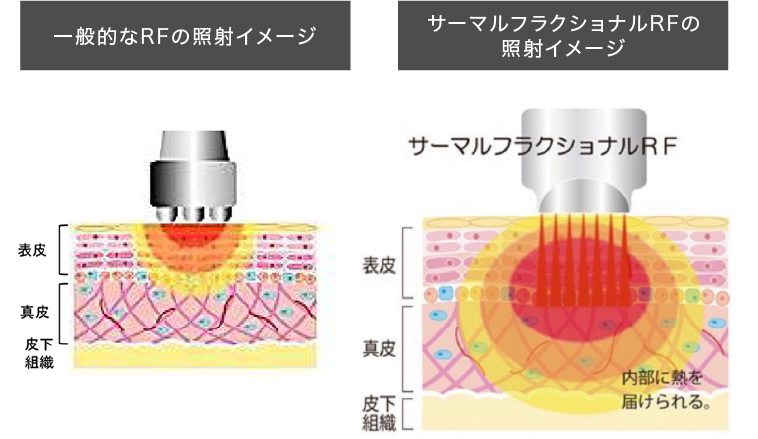 高性能の美肌・小顔機器の画像